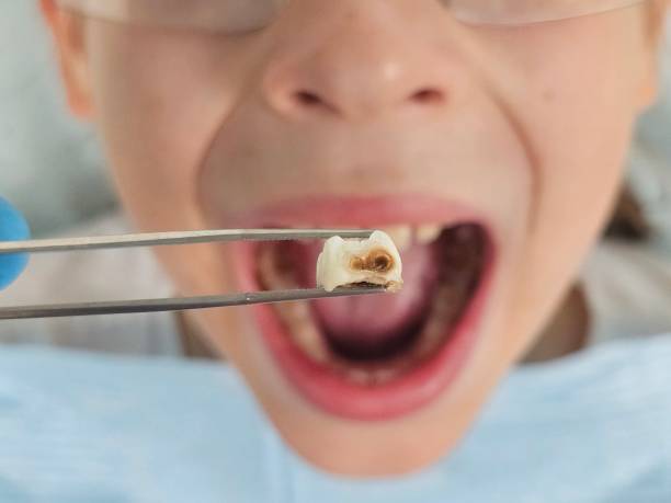 Best Knocked-Out Tooth Emergency  in Foster City, CA