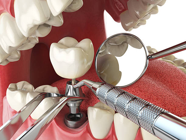 Best Broken Tooth Emergency  in Foster City, CA